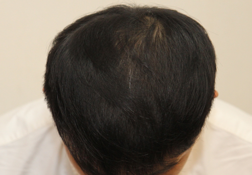 1 month after hair loss treatment