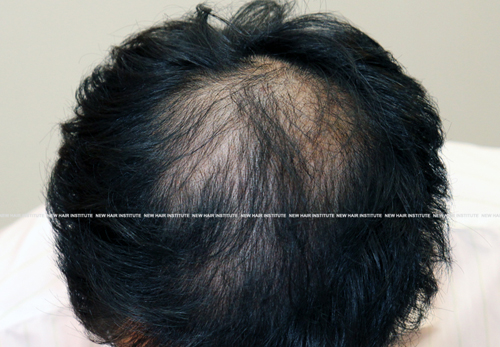 6 months after hair loss treatment