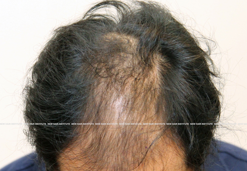 1 month before hair loss treatment