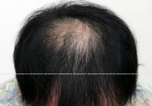 1 month before hair loss treatment