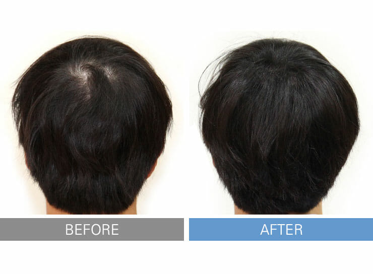 Immediately after SMP procedure > Inewhair