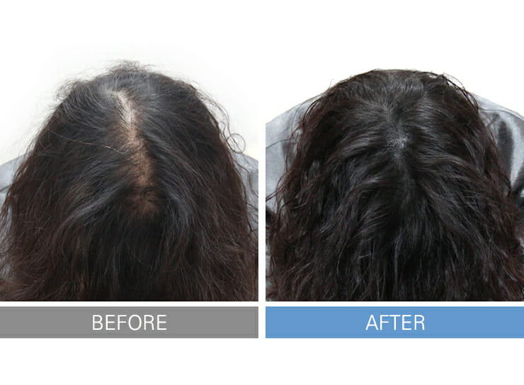 3 months after SMP procedure > Inewhair
