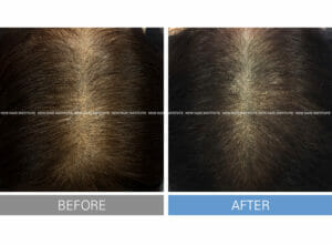 Hair loss treatment Exosome + Botox-12 times