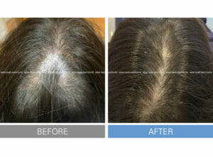 Hair loss treatment Exosome + Botox 12 times