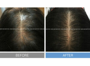 Hair loss treatment after changing to Exosome + Botox 24 times..