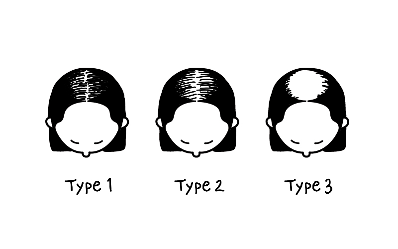 Hair Loss_Female Hair Loss Ludwick Stages