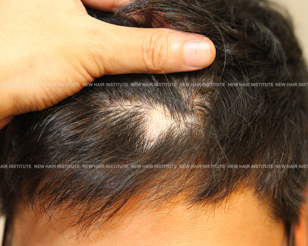 Hair loss_circular hair loss