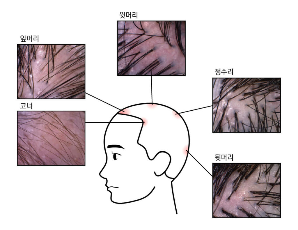 Hair Loss_Hair Mapping