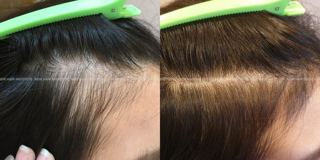 보톡스로 잔머리 만들기(보톡스 3회 치료 전후 치료 3개월 후)