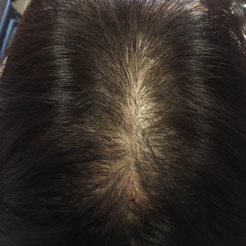 Female pattern hair loss (3)_New Hair Clinic_inewhair
