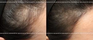 잔머리가 있는 헤어라인 문신 전후 비교